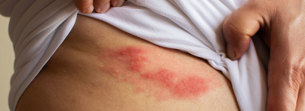 Shingles: Causes Symptoms and Treatment